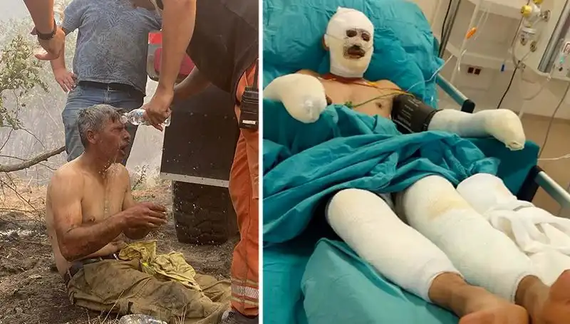 Yanıyorum Diyerek Yardım İsteyen Orman İşçisi: Tedavi Süreci Devam Ediyor