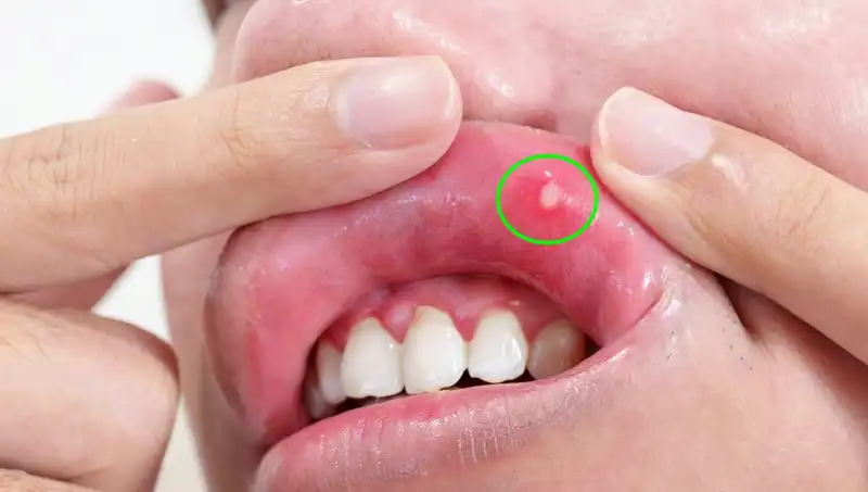B Vitaminleri Eksikliği: Vücudunuzun Gösterdiği 5 Belirtiyi Keşfedin